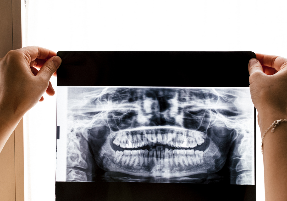 Bruksizm - uszkodzenie zębów
